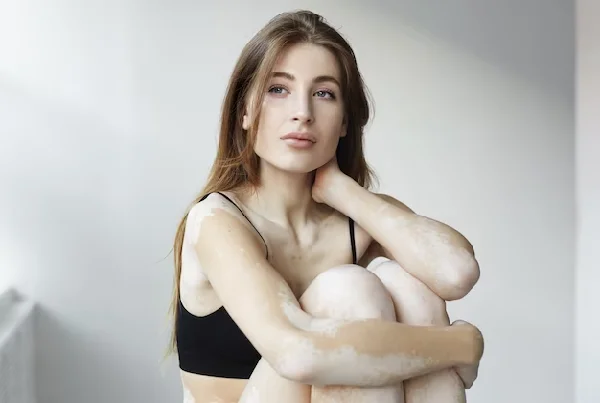 Vitiligo