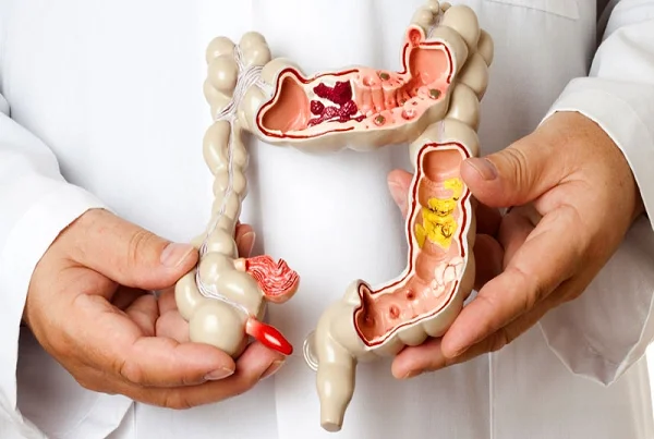 IBS