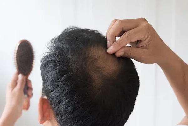 Hairfall