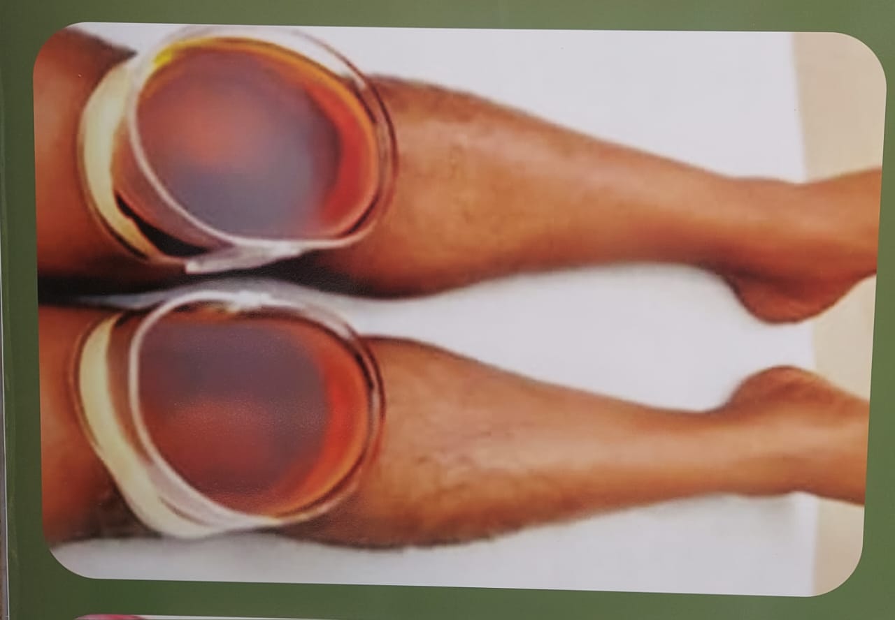 Janu Vasthi for Both Knee